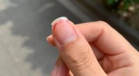 treat prevent quick nail injuries