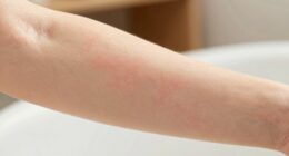 doodles on skin prevention